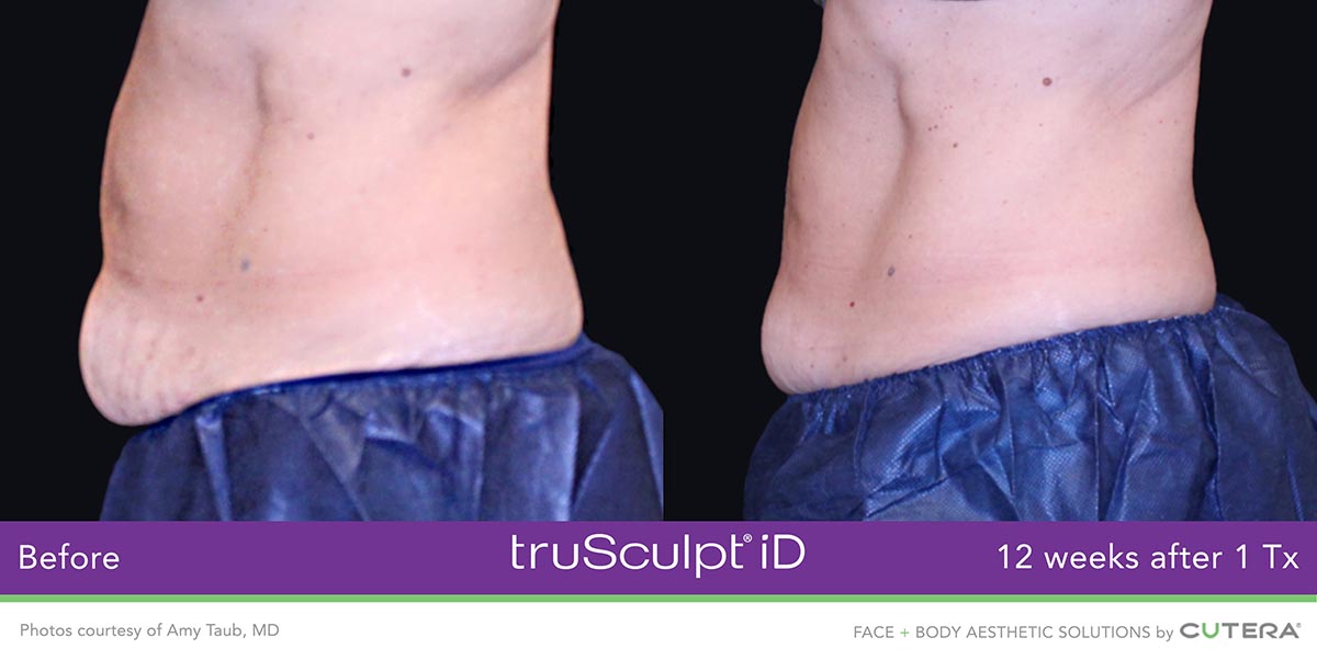 truSculpt-iD-Amy-Taub-MD-2