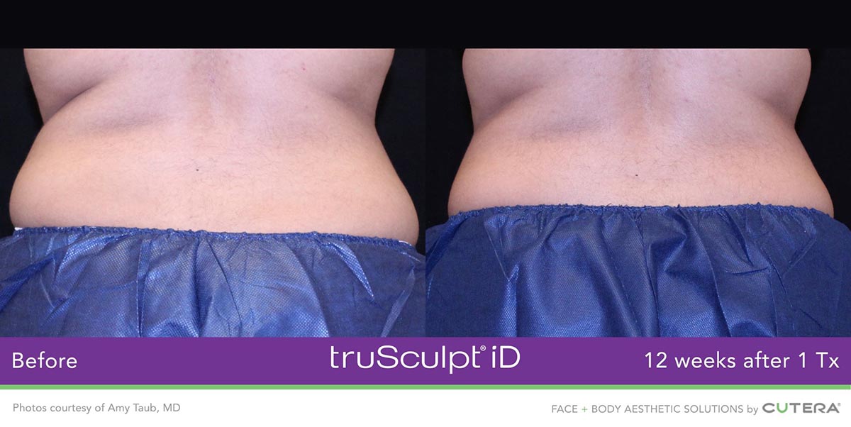 truSculpt-iD-Amy-Taub-MD-4